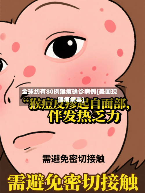 全球约有80例猴痘确诊病例(美国现猴痘病毒)-第2张图片